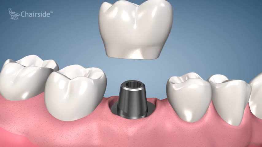 Dental Implant Procedure - One Stage