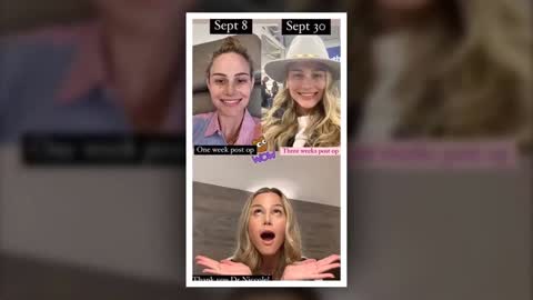 Meghan King Finally Shares Results of Her Plastic Surgery! Nose and Breast#meghan #surgery 