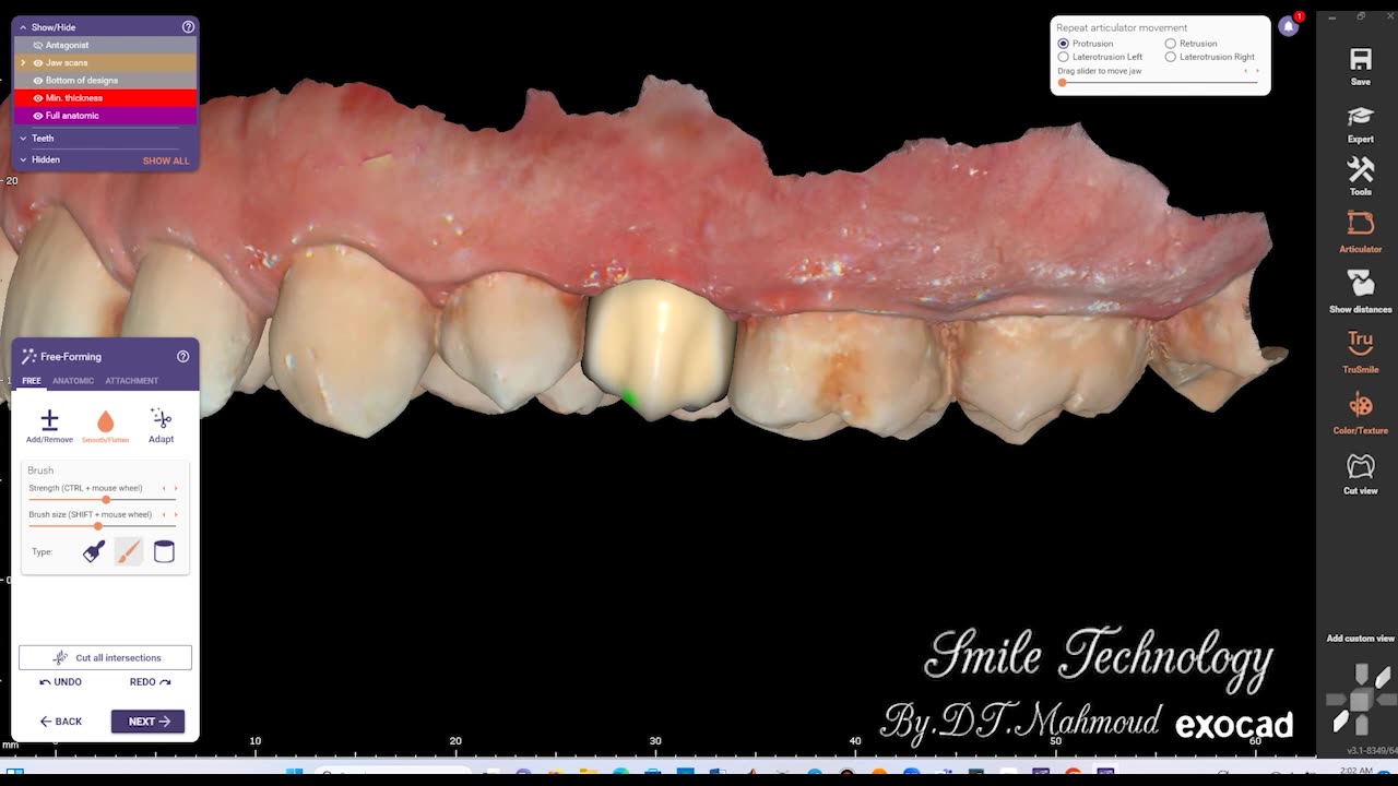 #design #naildesign #dental #dentaldesign #exocadexpert