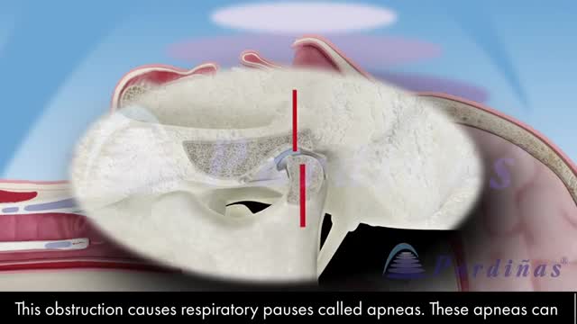 Snoring and Sleep Apnea