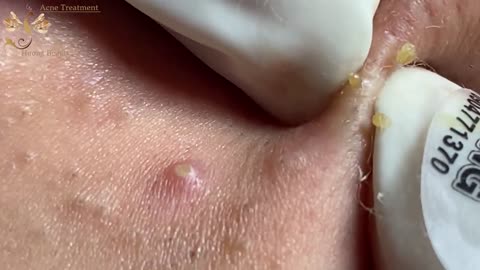 # 210 | Acne Treatment Huong beauty | Part 2 | Country girl