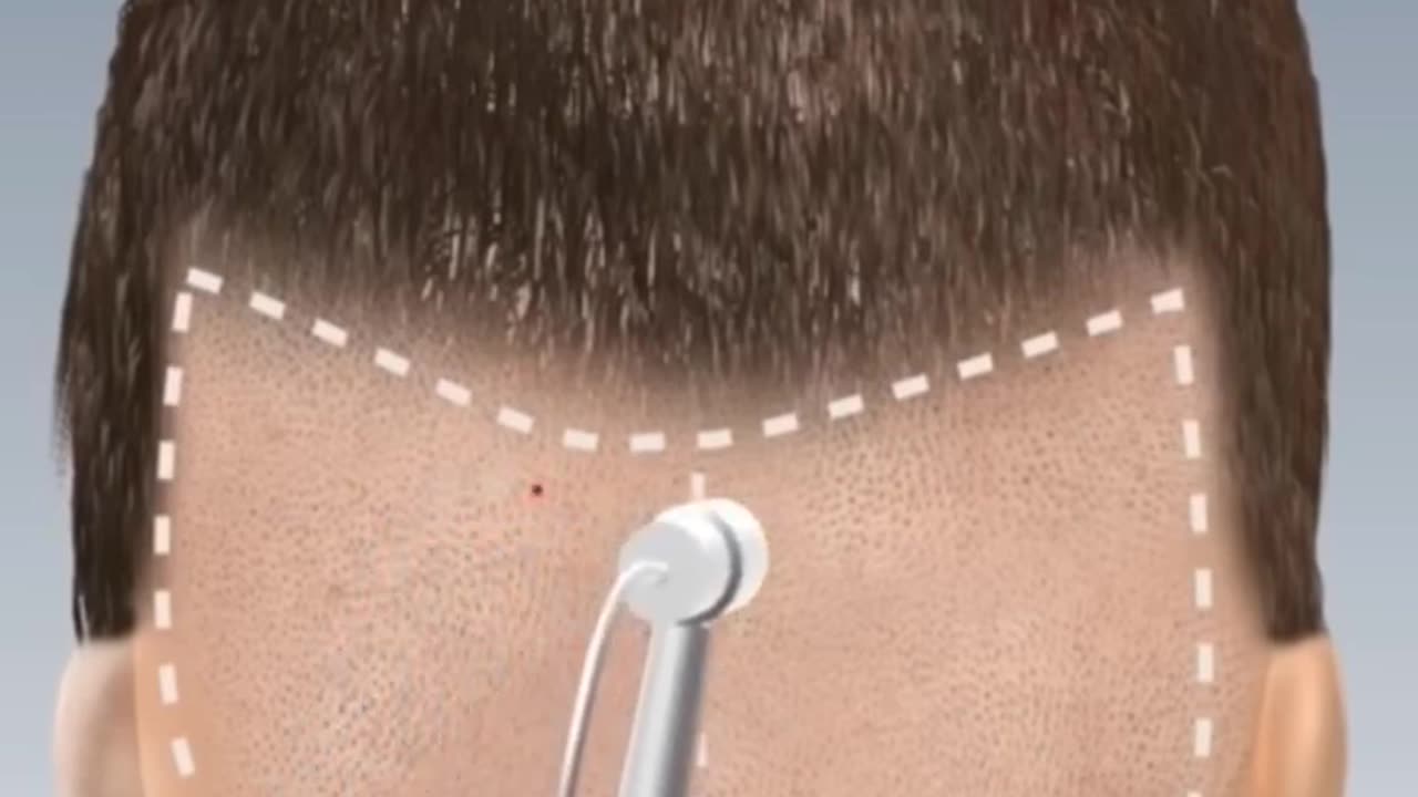 Hair transplant, how to grow new hair