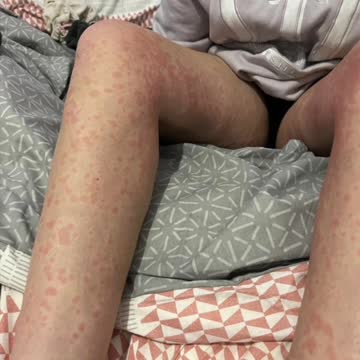 AstraZeneca Covid-19 Vaccine Injury