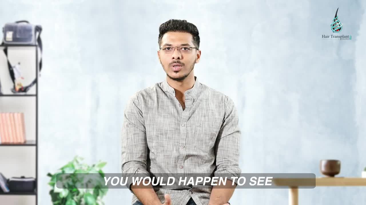 MY LIFE CHANGING 6 MONTHS JOURNEY OF FUE HAIR TRANSPLANT. BEST RESULT JOEL