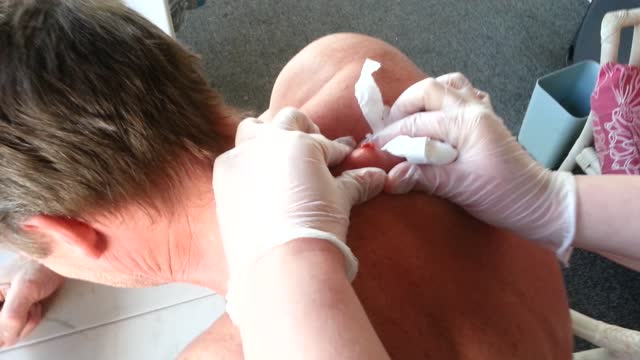 30 Year Old Cyst Explosion