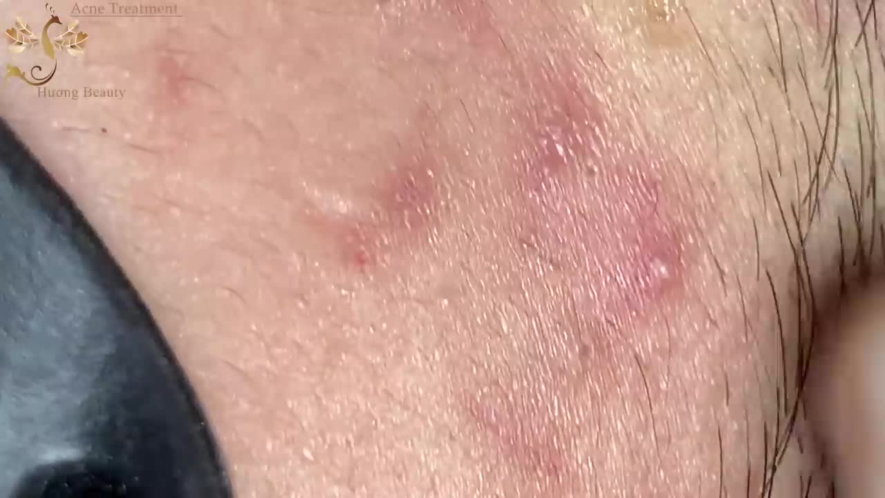 #094 | Acne Treatment Huong Beauty
