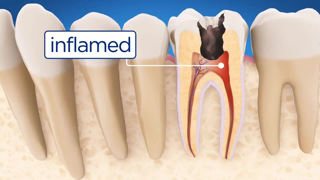 Dental Root Canal Treatment RCT