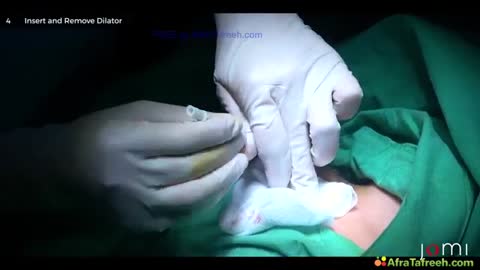 5. Blind Technique for Subclavian Central Line Placement