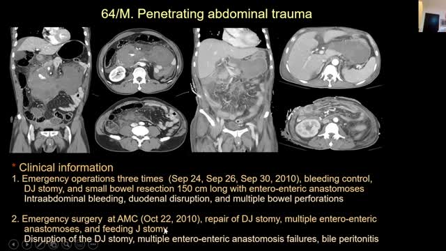 No.11- SEMS Rx vs. Gastrostomia vs. SEMS Endoscopico. Dr Ho-Young Song