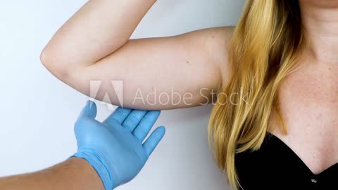 Body Shaper After Medical Arm Liposuction