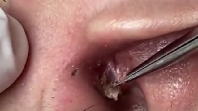 Black Head Removal in the ear