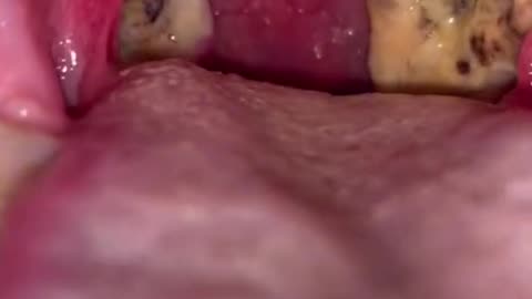 Tonsil Stones Removal #tonsillstone #tonsils #amigdalolitos