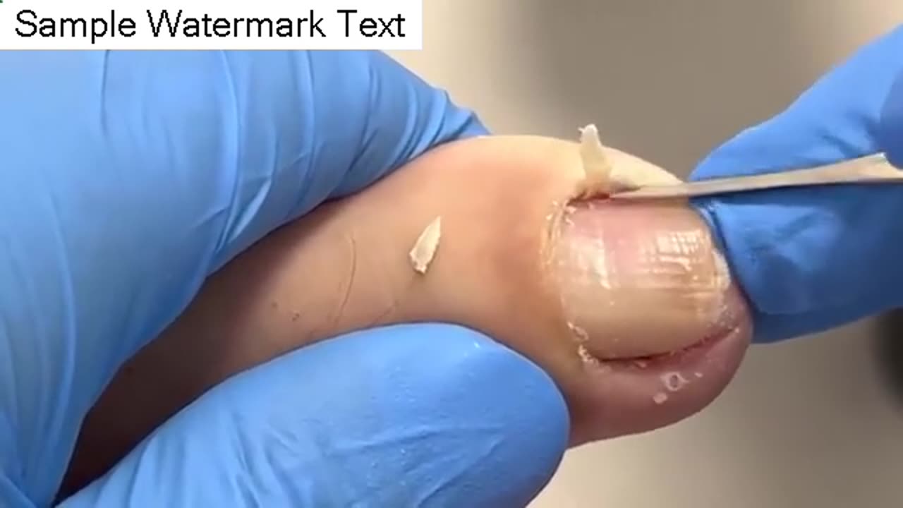 A sunken nail
