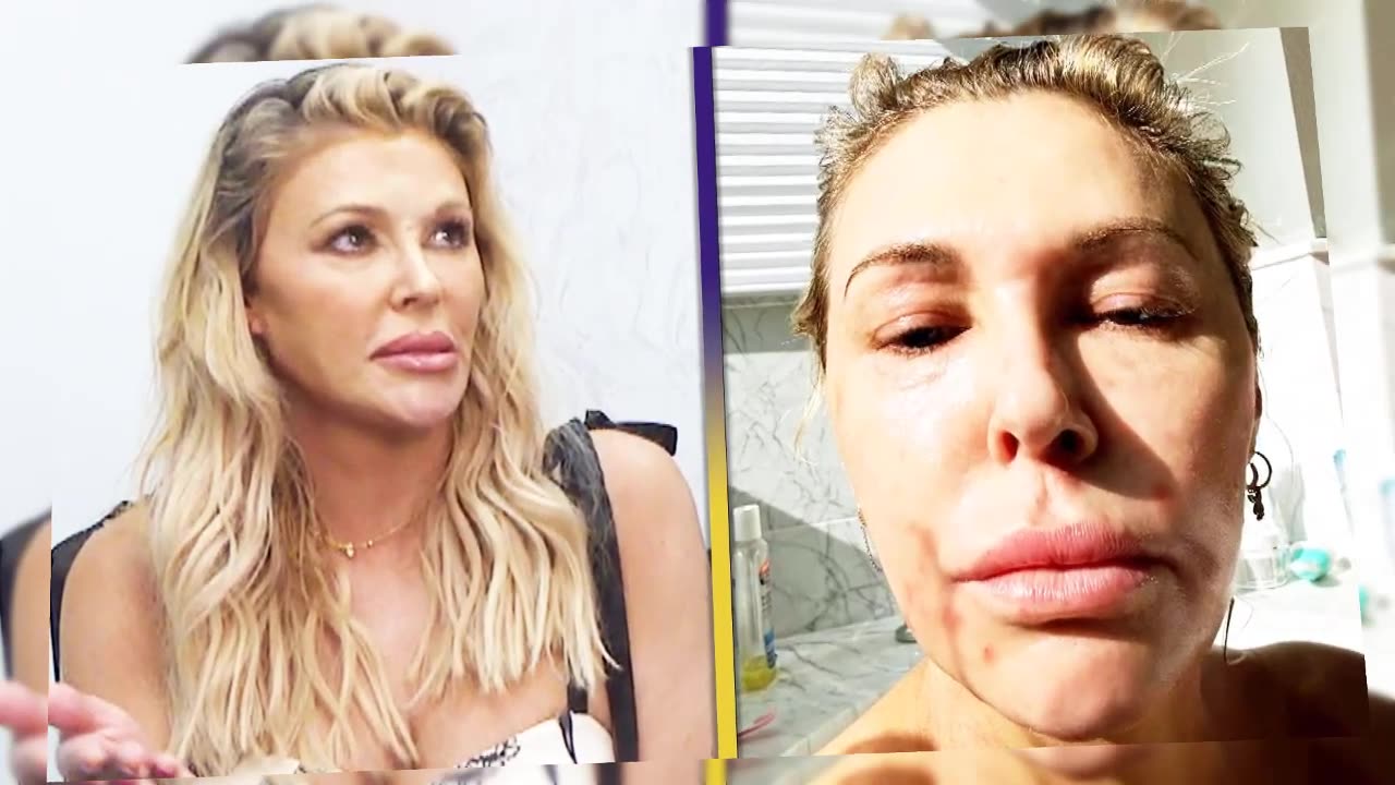 Brandi Glanville’s $70K Battle with a Mysterious ‘Parasite’ She Claims Moves & Breeds in Her Face