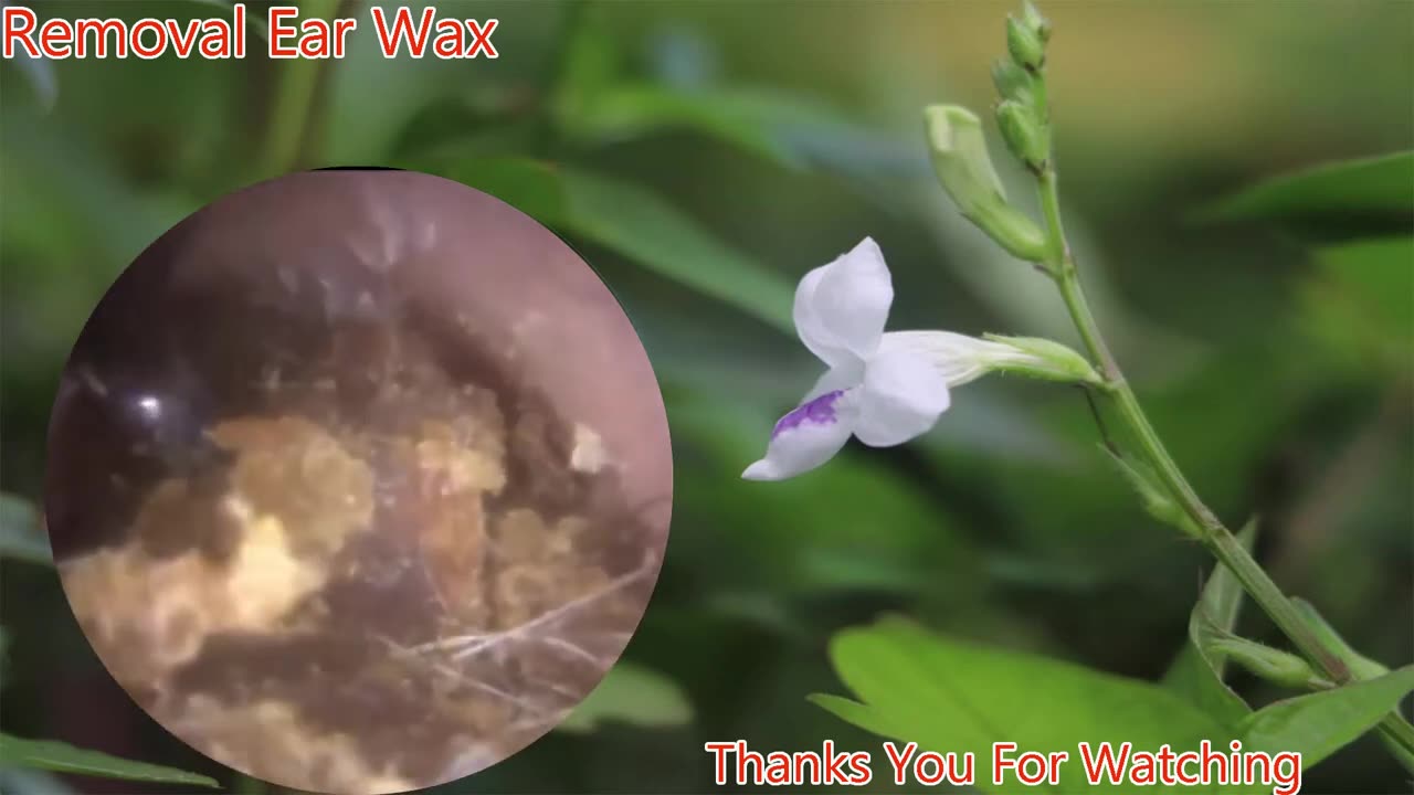 gigantic ear wax removal #10