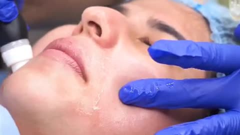 Hydrafacial treatment || Beauty in Grace