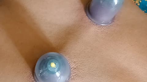 Cupping for Backside of the body