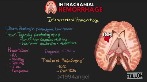 Intracranial hemorrhage