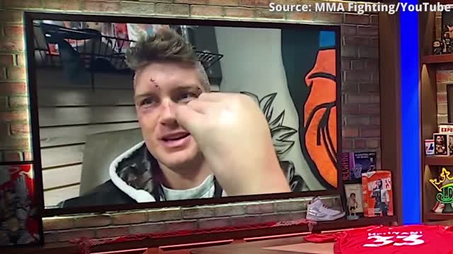 Stephen Thompson shows off badly swollen broken hand from Kevin Holland fight