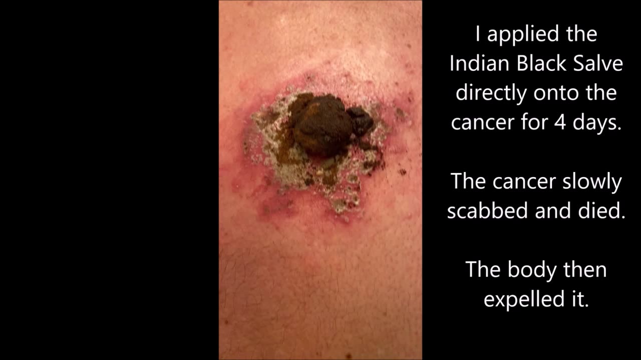 Instructions on how to use the Indian Black Salve