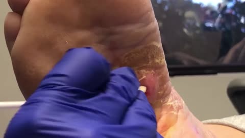 INSANE INCLUSION CYST