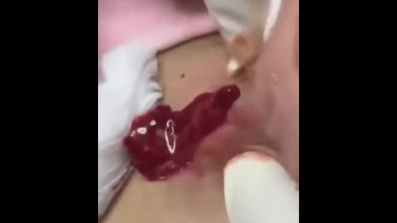 CYSTS EXTRACTED HUGE INFECTED ACNE TREATMENT