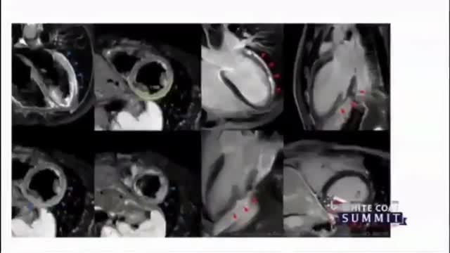 Doctor talking about Spike Proteins/Toxins being the disease - Covid-19 Part 2 of 3