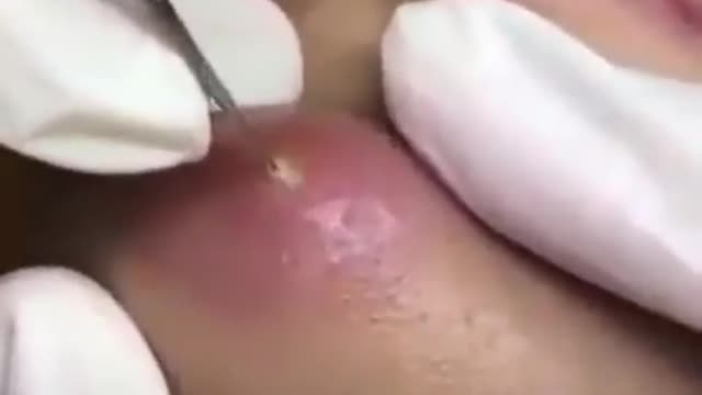 pimples