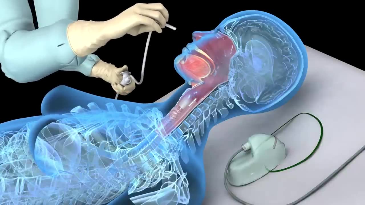 Nasotracheal suctioning (NTS) - 3D animation