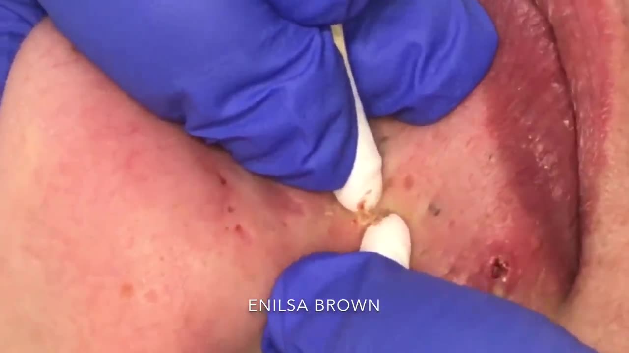 Iris blackhead extraction