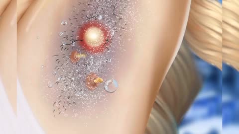 ASMR_Remove_Big_Acne____Infected____Deep_Cleaning_Animation