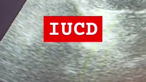 #iucd with slightly bulky uterus