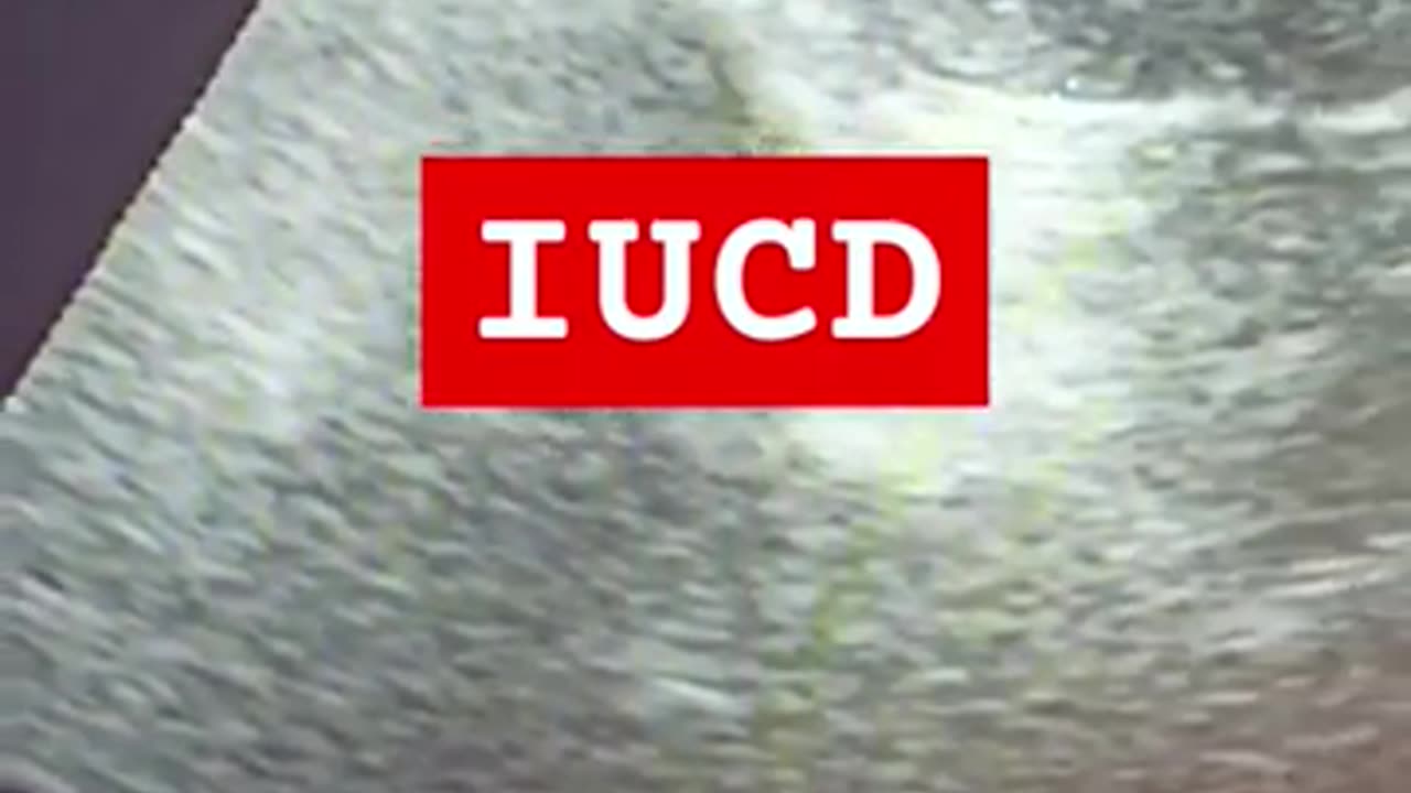 #iucd with slightly bulky uterus