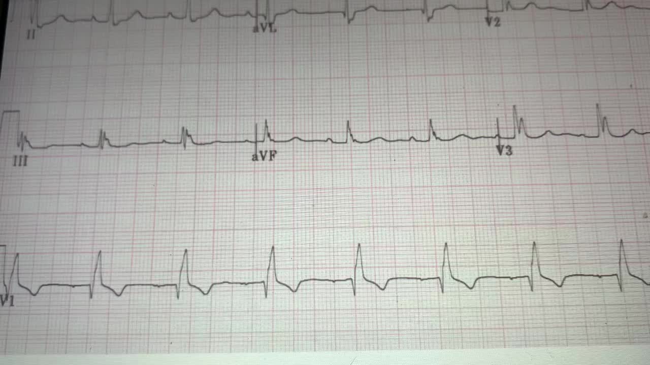 Routine ECGs/EKGs