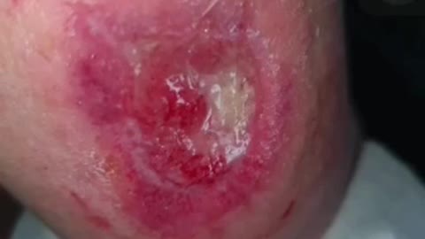 תופעת לוואי קשה פגיעה בעור חורים ודלקות אחרי חיסון