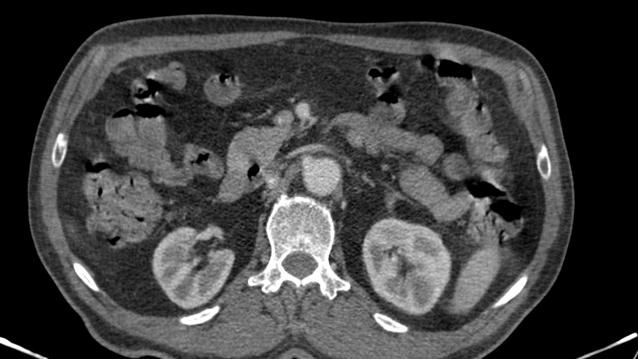 Abdominal CT angiography, axial view