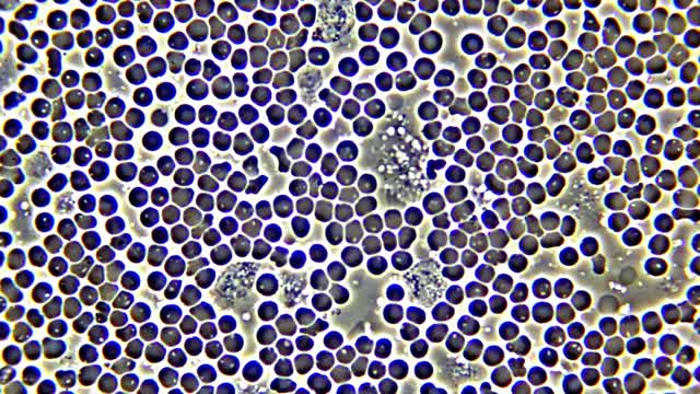 White blood cell phagocytes moving in blood, with red blood cell hemolysis.