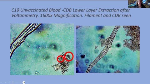 Blood Analysis- from Covid JABS- -Nano -Tech -Circuitry Dr. Anna Mihalcea - Even Unvaxxed People