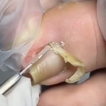 INGROWN Nail Removal, Nail Fixing, and Nail Cleaning.!!!!