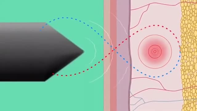 Saúde através da tecnologia do plasma?