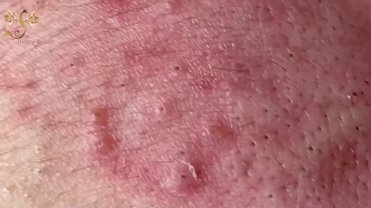 #174 | Acne Treatment Huong beauty