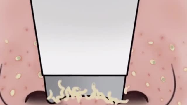 Blackheads Remove Fast