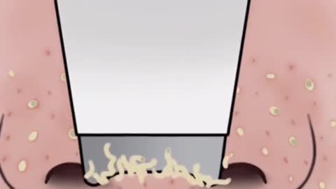 Blackheads Remove Fast