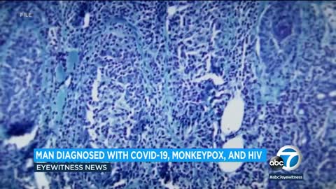 Man gets COVID-19, monkeypox and HIV diagnosed all at the same time!