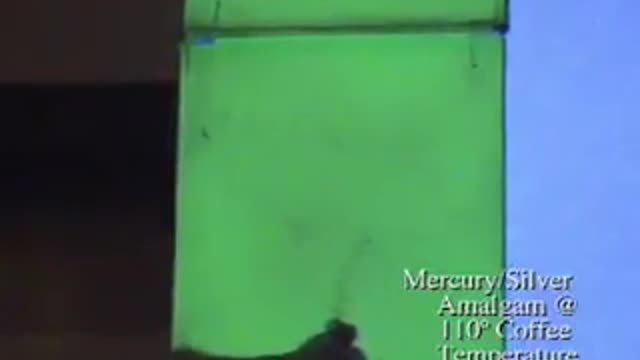 Amalgam (Mercury) Fillings