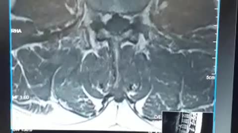 Magnetic resonance imaging of the spine