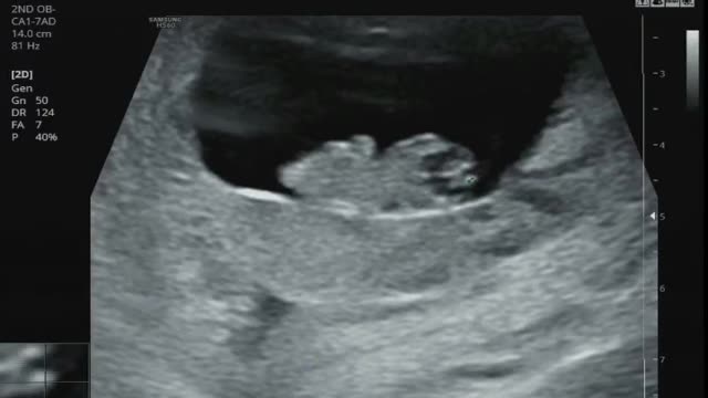 pregnant / 9wdd (3monthspregnant)
