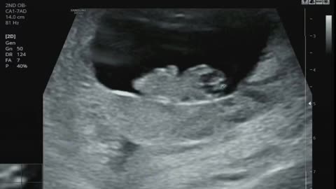 pregnant / 9wdd (3monthspregnant)