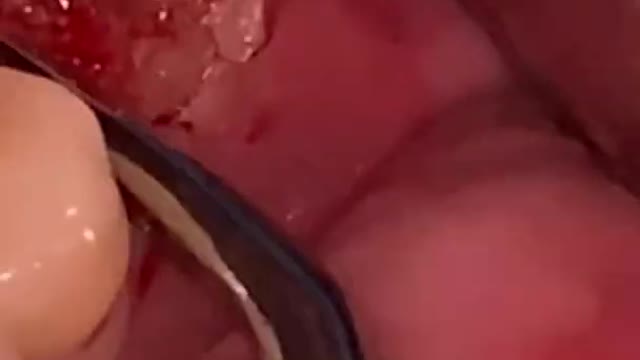 Remaining Tooth Root Extraction #shorts #dentist