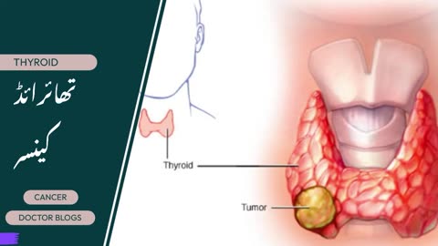 تھائرائڈ کینسر کا علاج